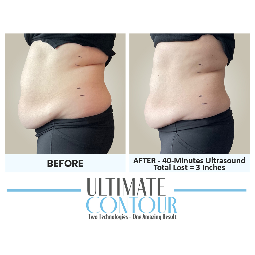 Before and after Ultimate Contour body contouring results for client 15 at Healthy Living Medical in Texarkana, TX