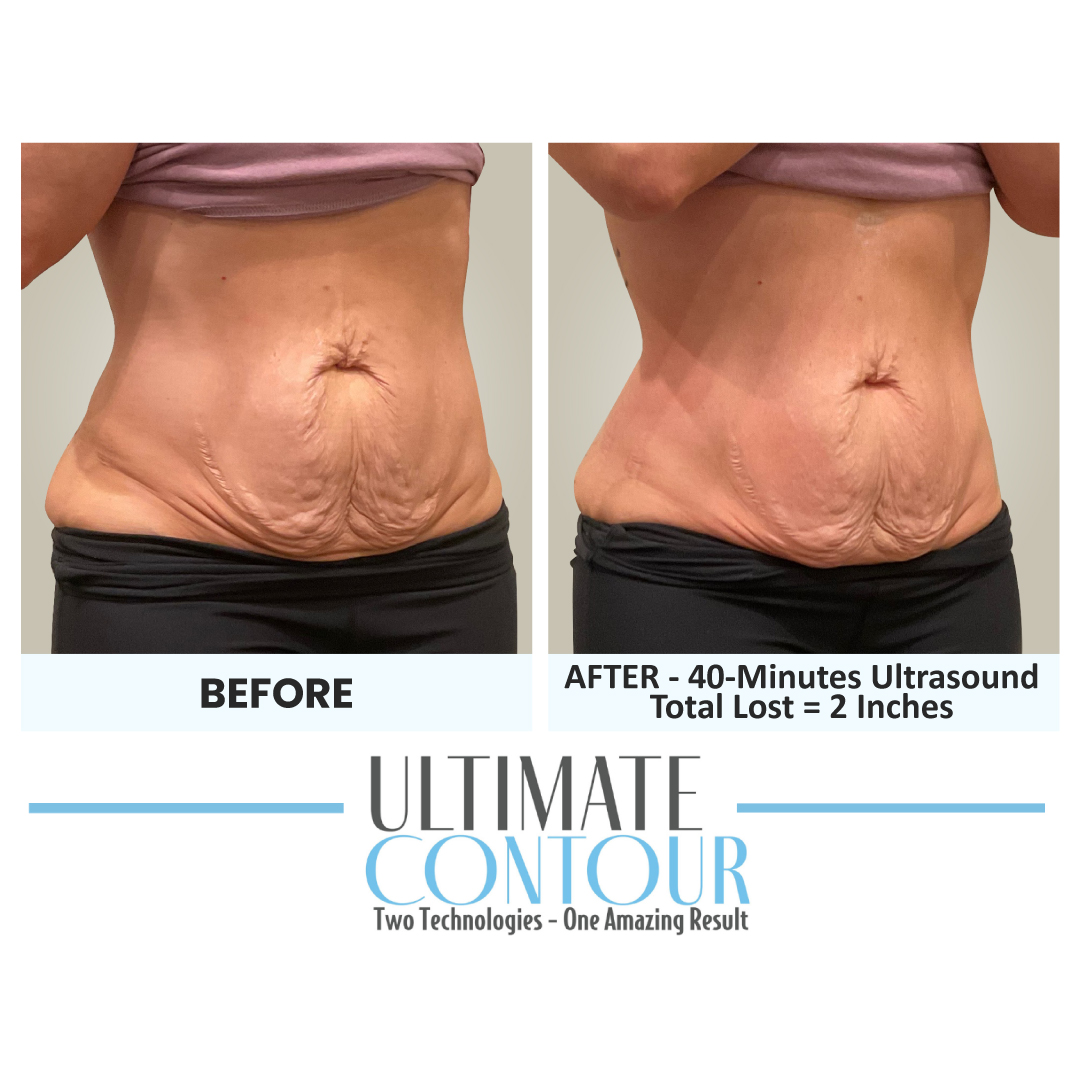 Before and after Ultimate Contour body contouring results for client 16 at Healthy Living Medical in Texarkana, TX