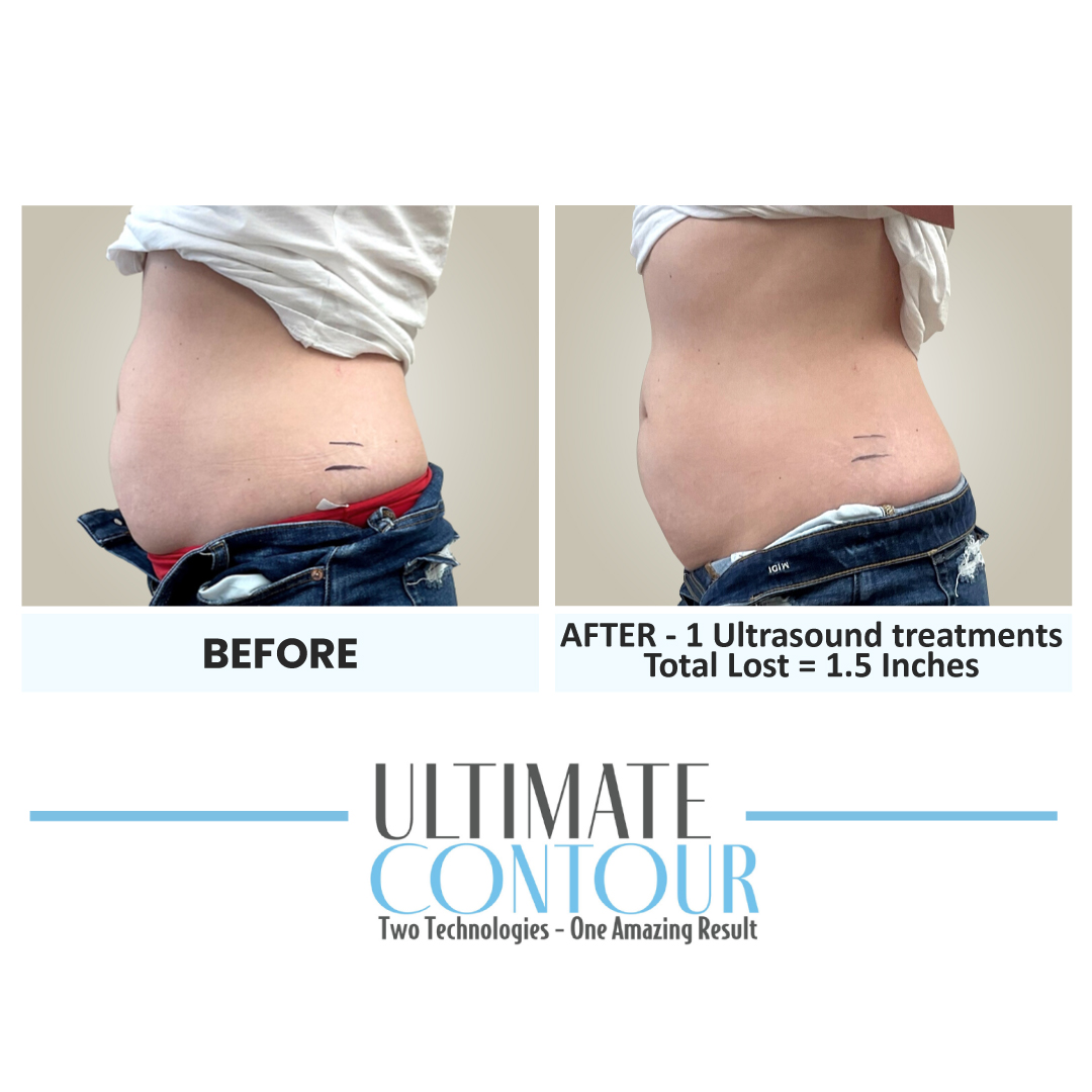 Before and after Ultimate Contour body contouring results for client 17 at Healthy Living Medical in Texarkana, TX