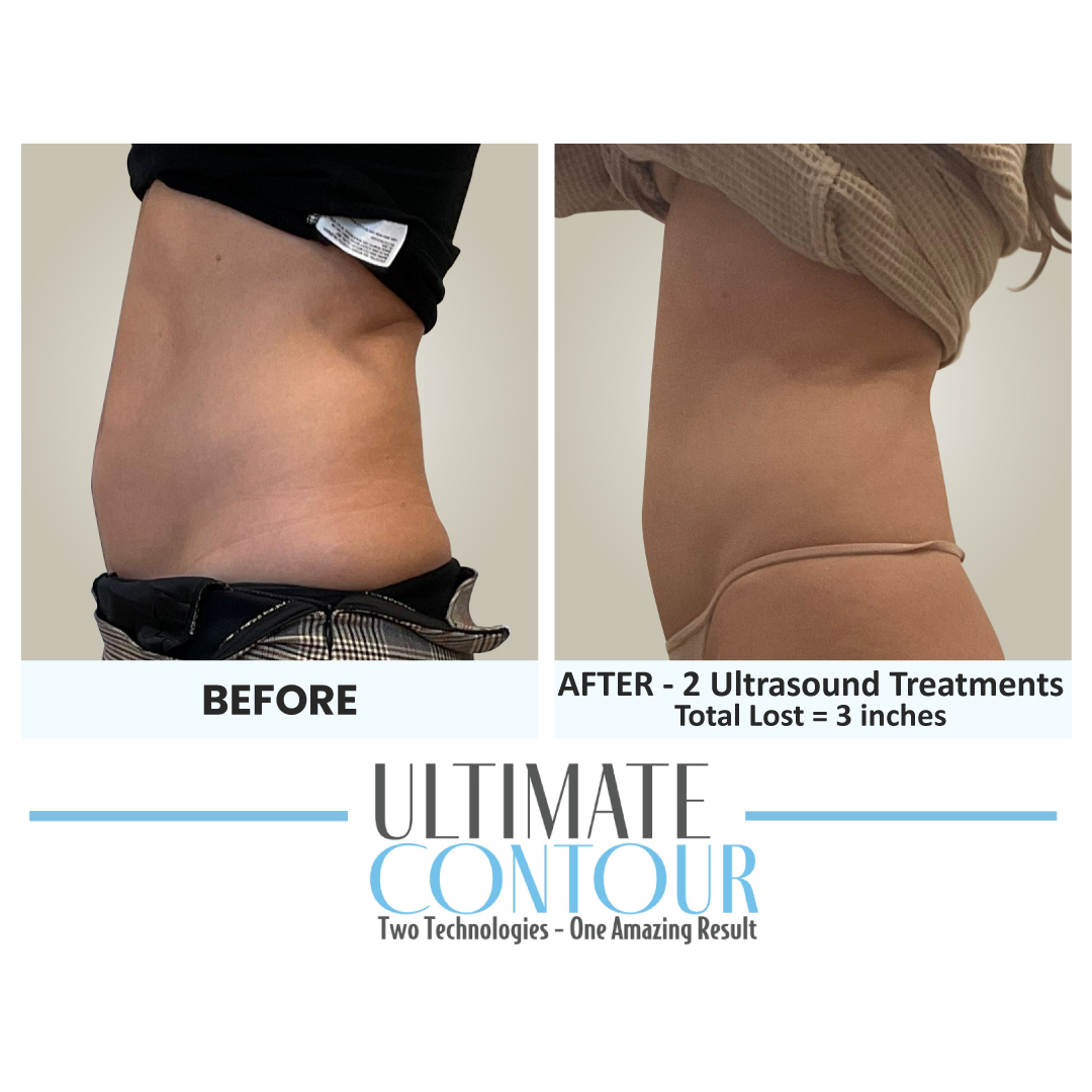 Before and after Ultimate Contour body contouring results for client 14 at Healthy Living Medical in Texarkana, TX