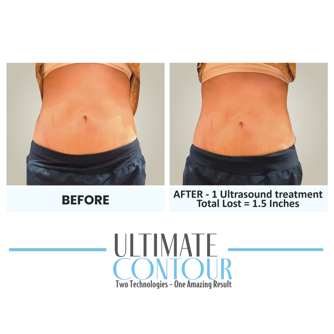Before and after Ultimate Contour body contouring results for client 19 at Healthy Living Medical in Texarkana, TX