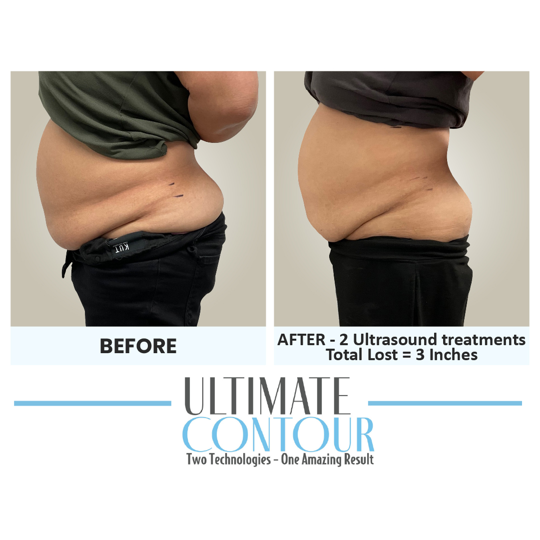 Before and after Ultimate Contour body contouring results for client 22 at Healthy Living Medical in Texarkana, TX