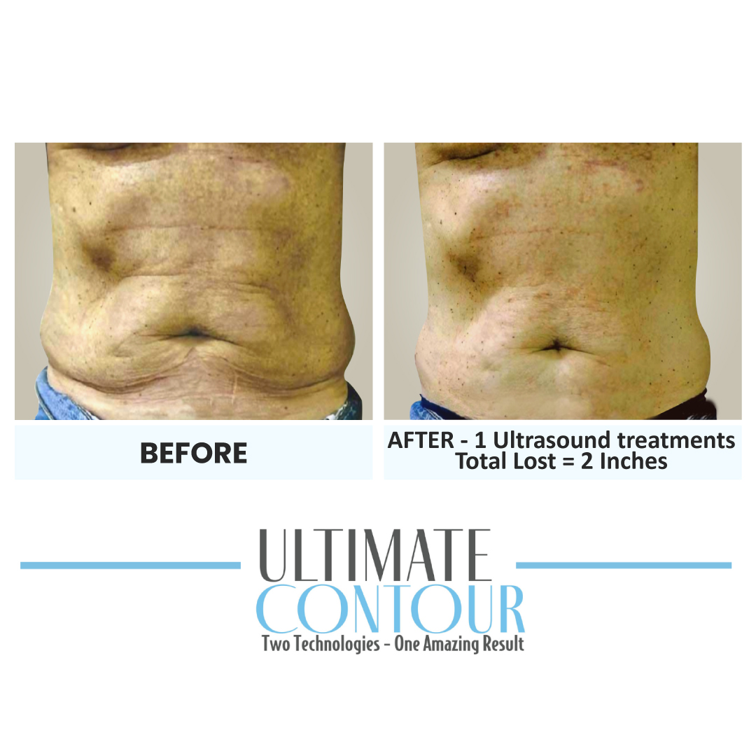 Before and after Ultimate Contour body contouring results for client 21 at Healthy Living Medical in Texarkana, TX