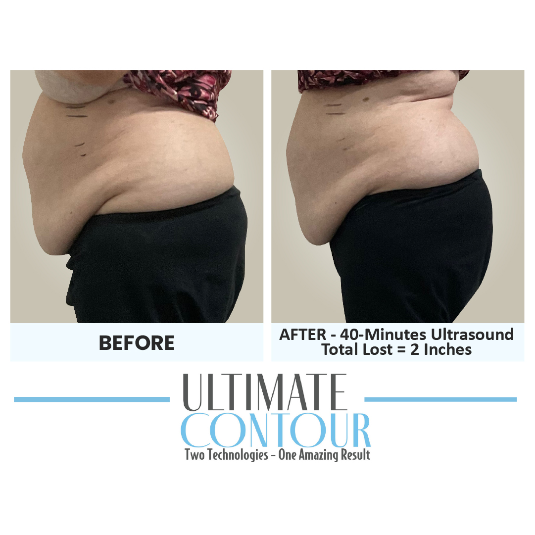 Before and after Ultimate Contour body contouring results for client 20 at Healthy Living Medical in Texarkana, TX