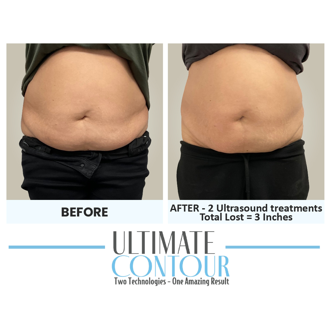 Before and after Ultimate Contour body contouring results for client 23 at Healthy Living Medical in Texarkana, TX
