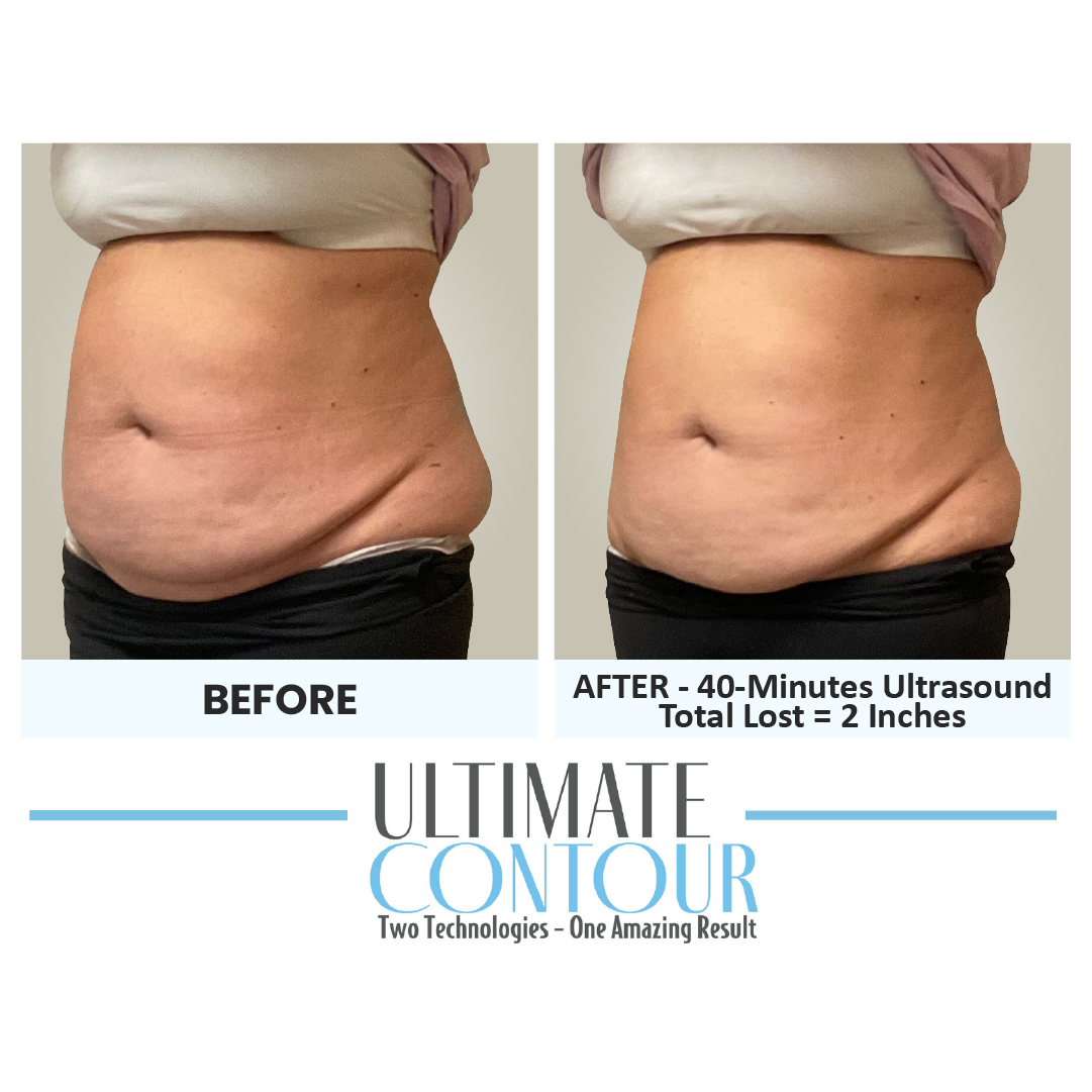 Before and after Ultimate Contour body contouring results for client 24 at Healthy Living Medical in Texarkana, TX
