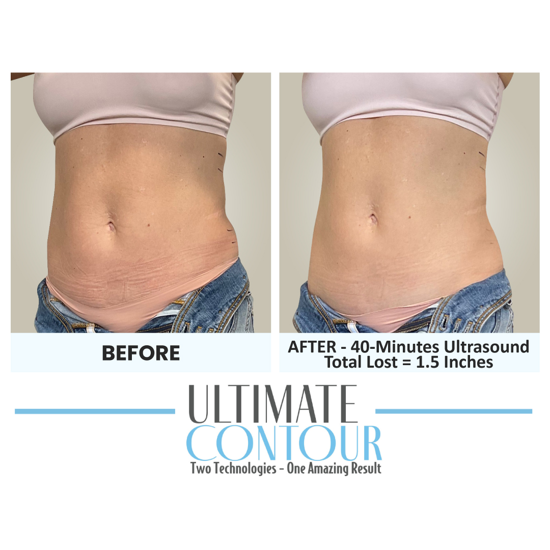 Before and after Ultimate Contour body contouring results for client 25 at Healthy Living Medical in Texarkana, TX
