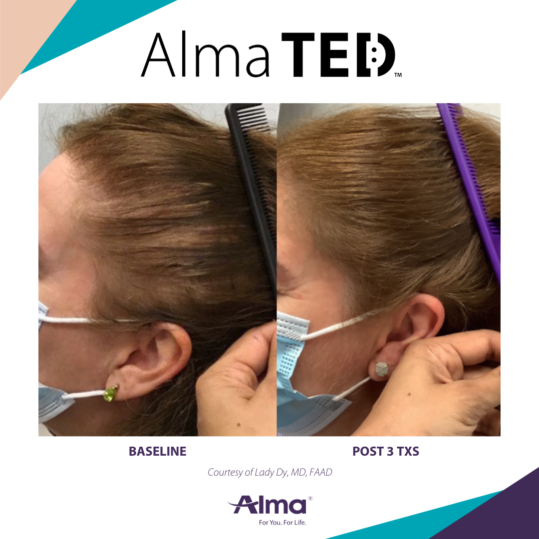 Before and after TED hair restoration results for client 7 at Healthy Living Medical in Texarkana, TX