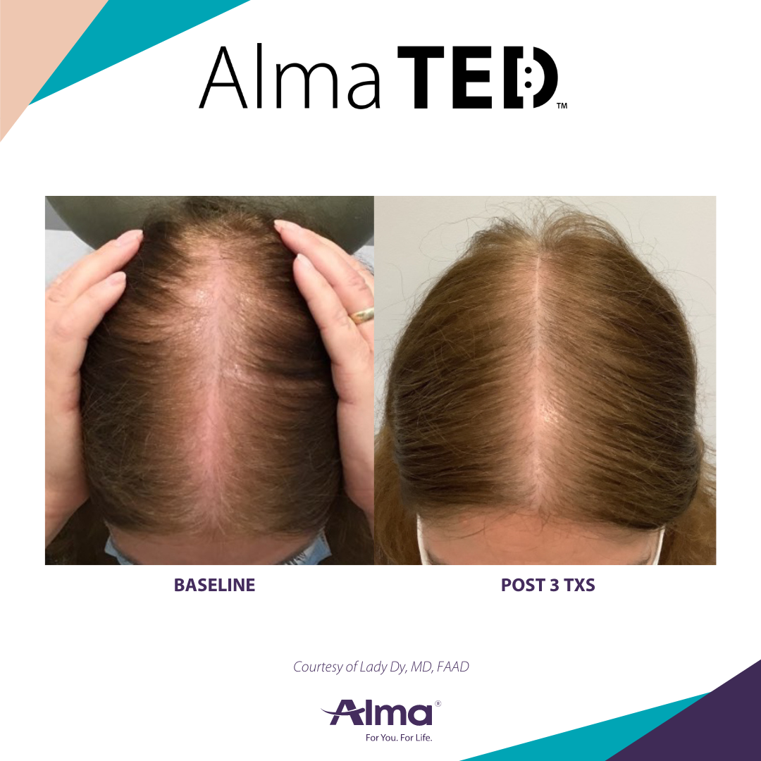 Before and after TED hair restoration results for client 6 at Healthy Living Medical in Texarkana, TX