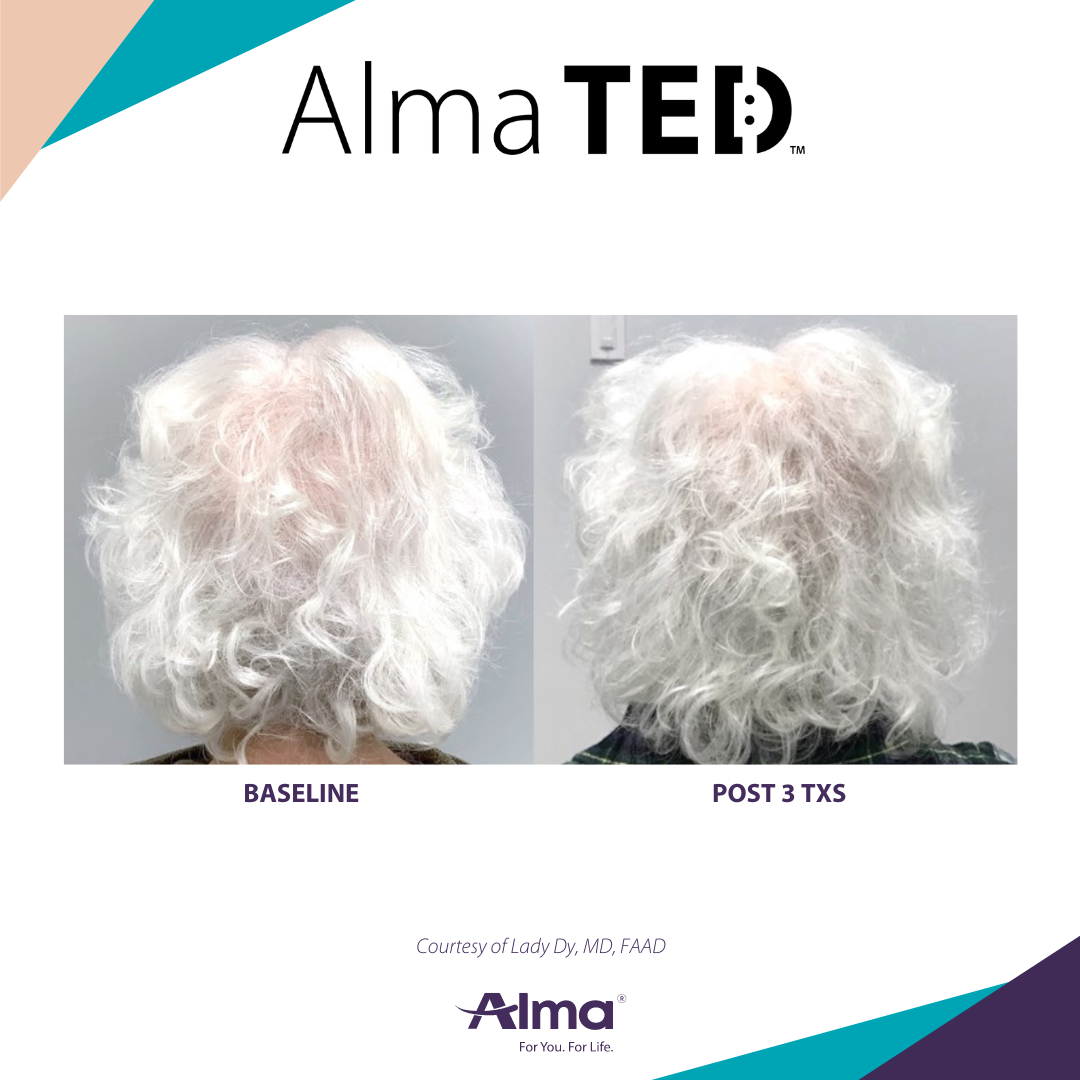 Before and after TED hair restoration results for client 5 at Healthy Living Medical in Texarkana, TX