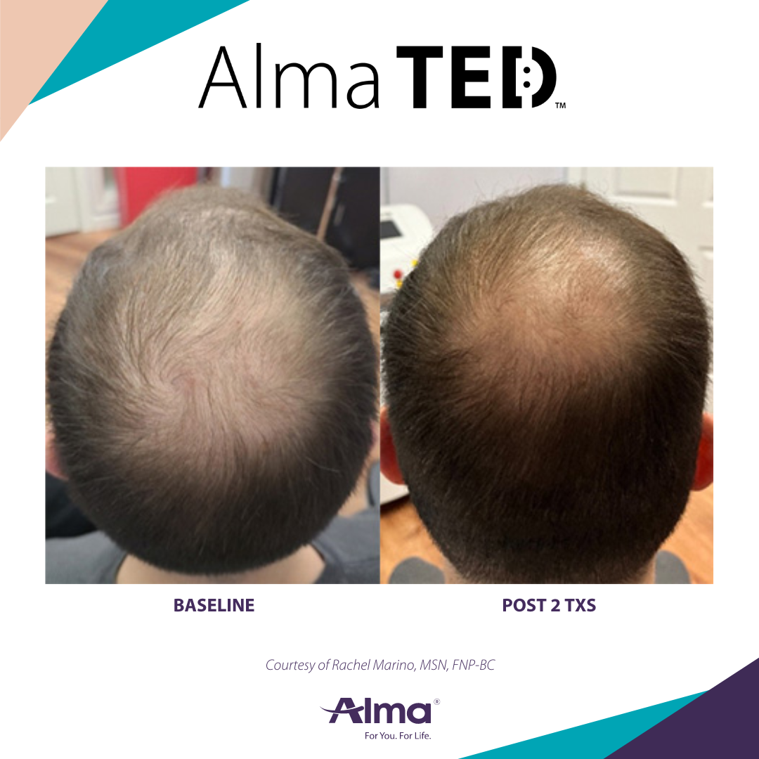 Before and after TED hair restoration results for client 2 at Healthy Living Medical in Texarkana, TX