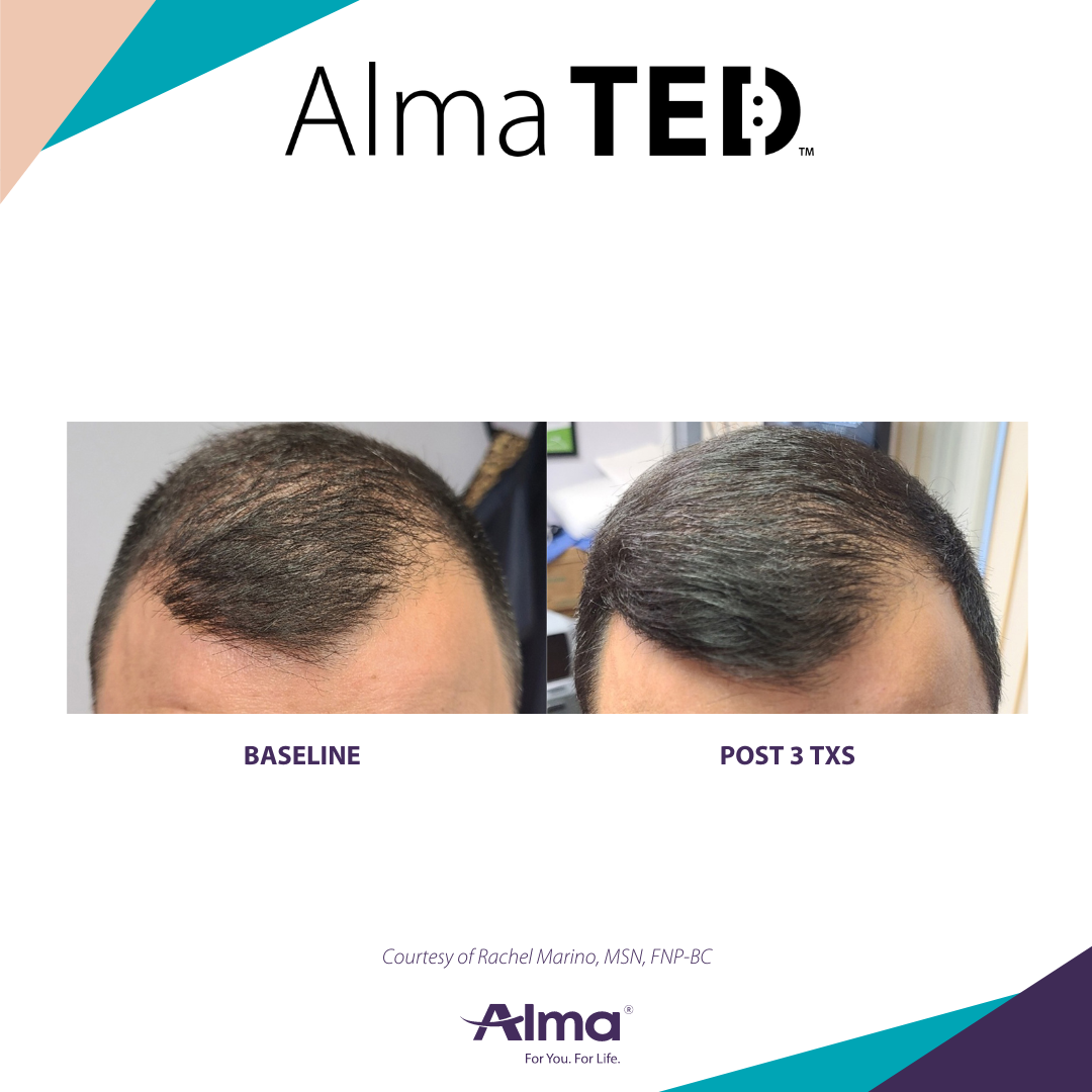 Before and after TED hair restoration results for client 1 at Healthy Living Medical in Texarkana, TX