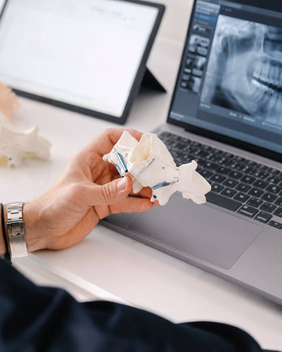 Ruka drži model čeljusti s implantatima ispred laptopa s rendgenskom slikom zuba.
