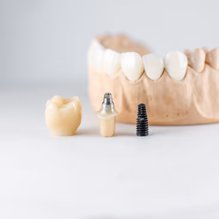 Prikaz plastičnog zubnog mosta, implantata i zavrtnja ispred modela gornje vilice.