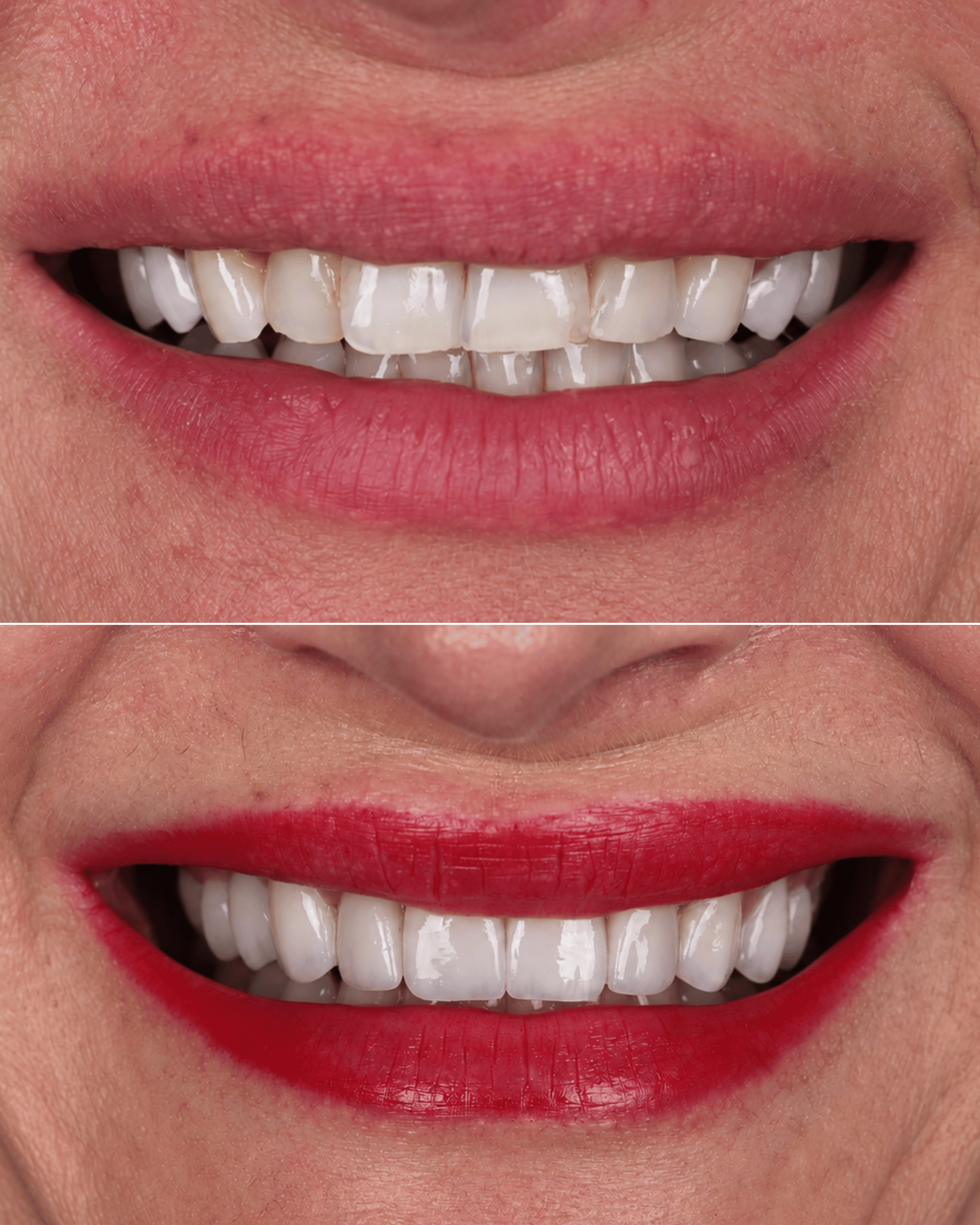Keramičke ljuskice | Miličić Dental Clinic