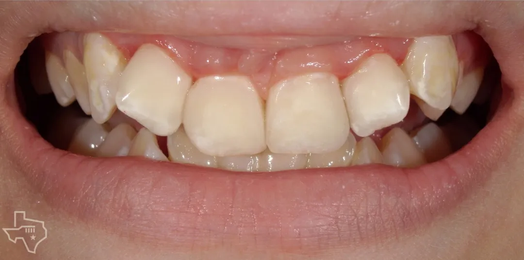 Veneers results, after treatment