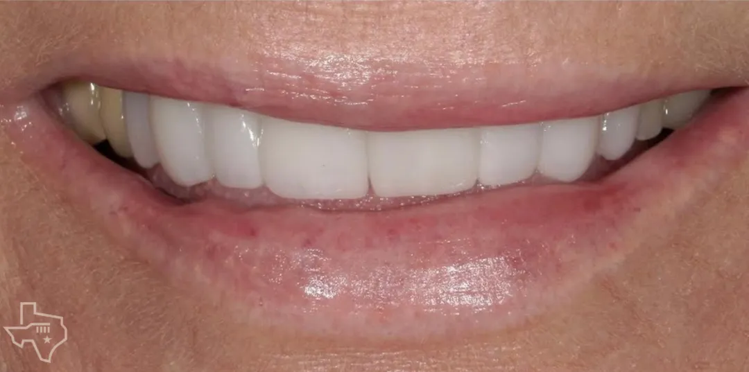 Veneers results, after treatment