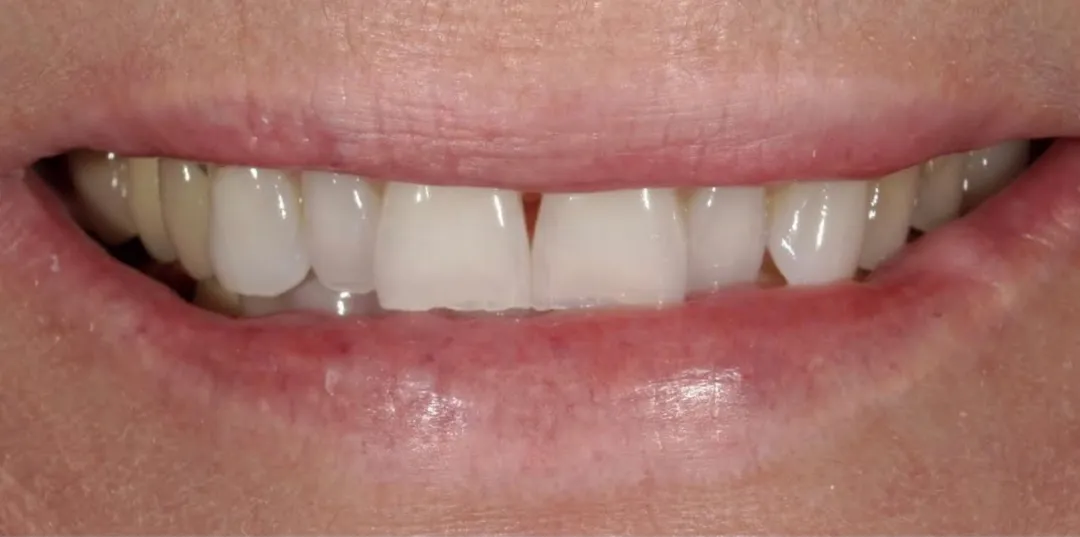 before and after treatment