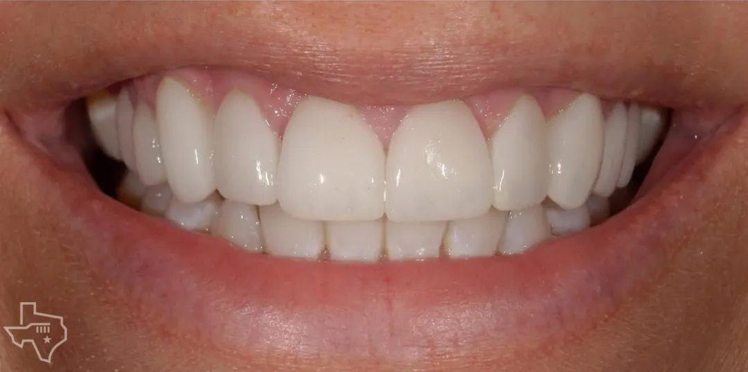 Veneers results, after treatment