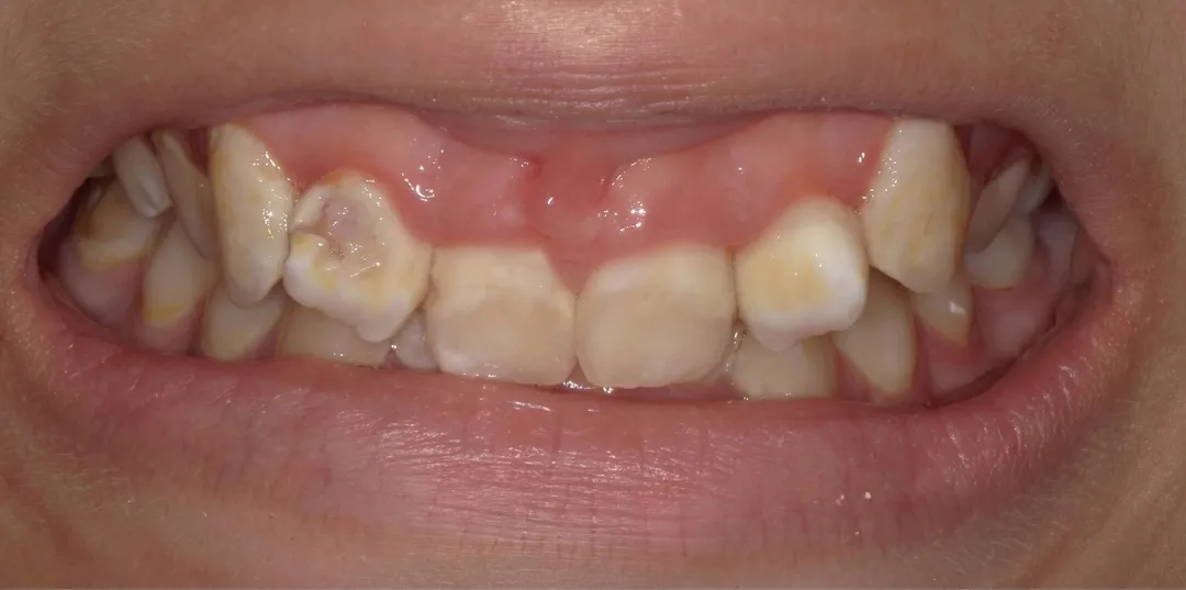 before and after treatment