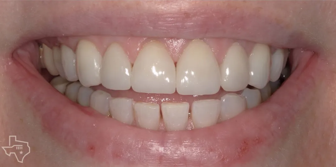 Veneers results, after treatment