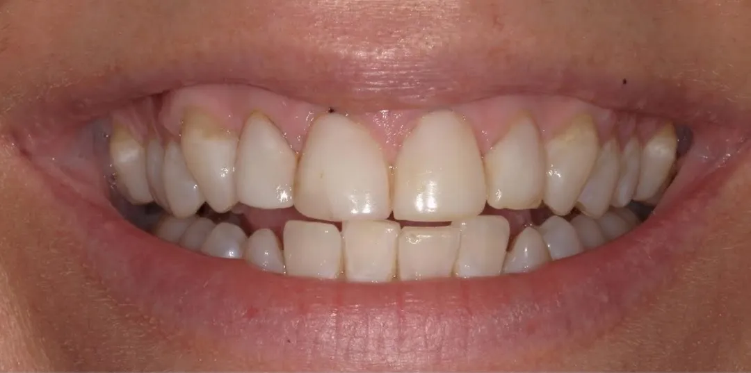 before and after treatment