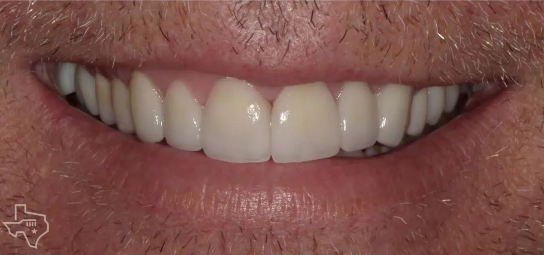 Veneers results, after treatment