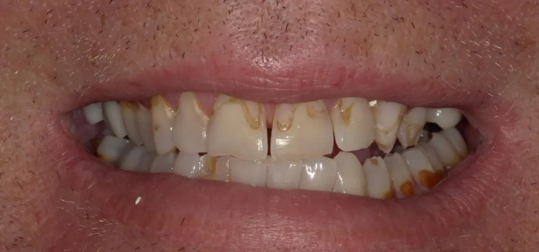 before and after treatment