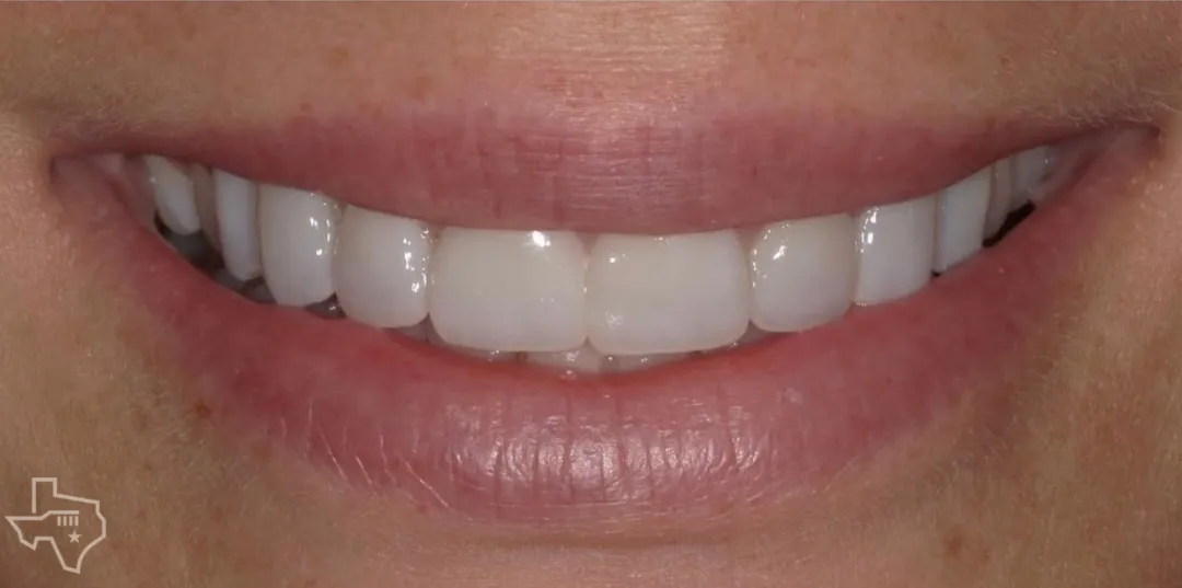 Veneers results, after treatment