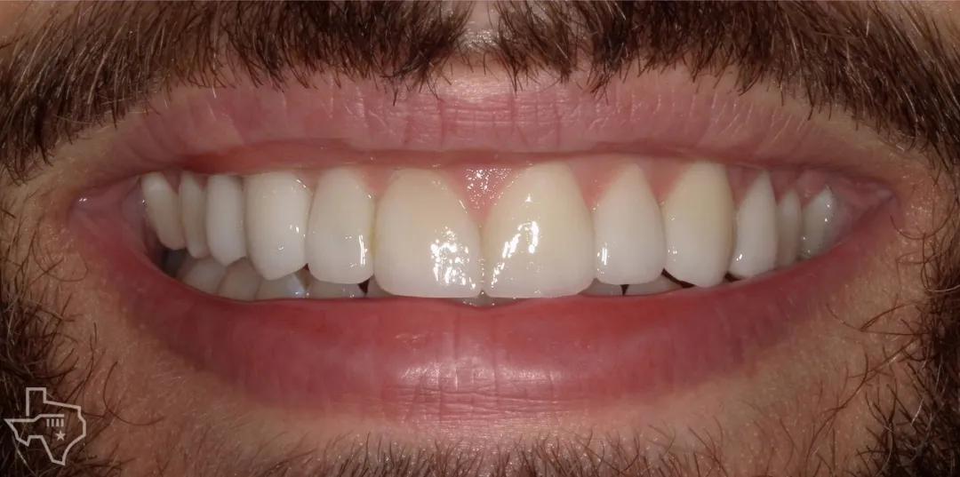 Veneers results, after treatment