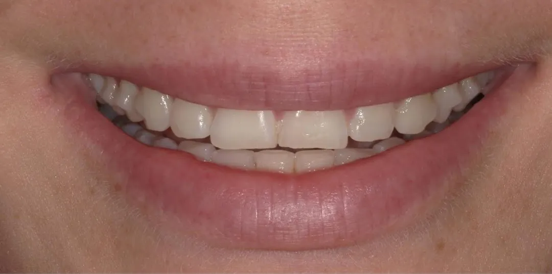 before and after treatment