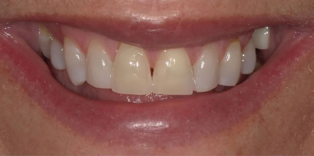 before and after treatment
