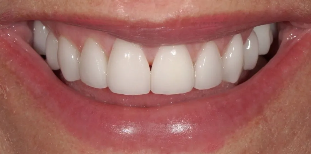 Veneers results, after treatment