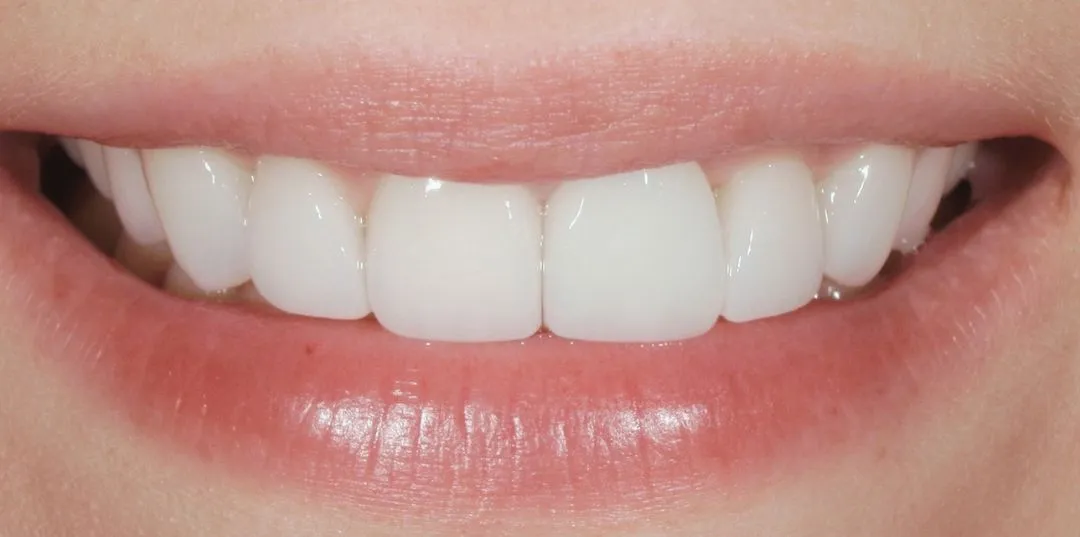 Veneers results, after treatment