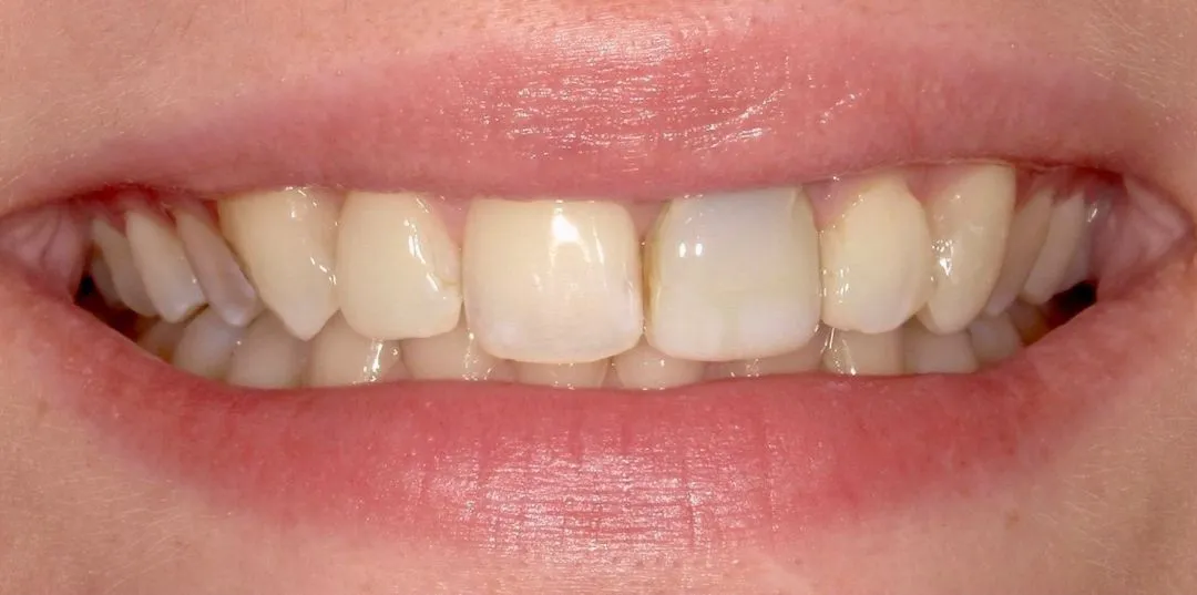 before and after treatment
