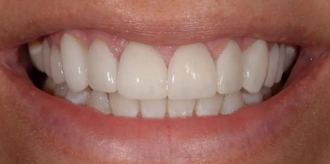 Veneers results, after treatment