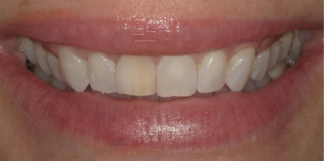 before and after treatment