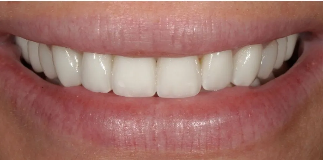 Veneers results, after treatment