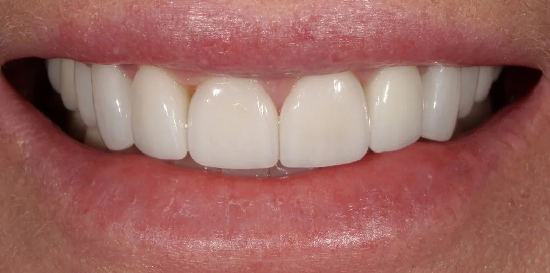 Veneers results, after treatment