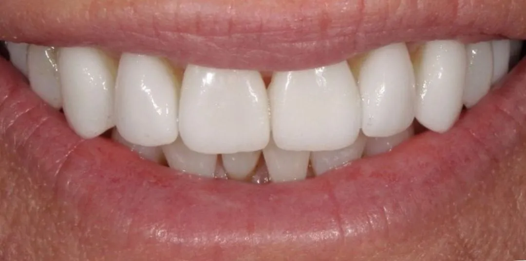 Veneers results, after treatment