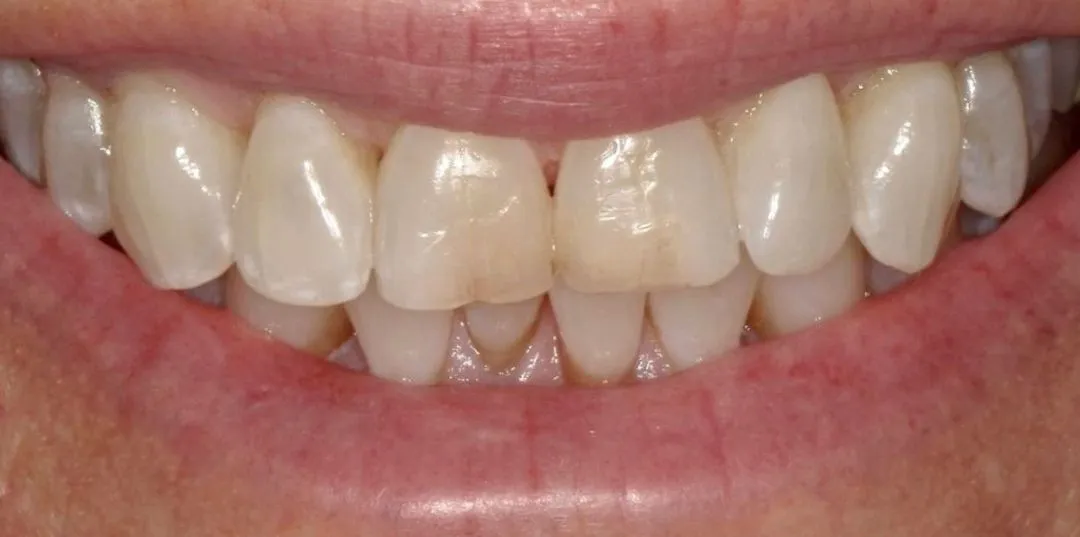 before and after treatment