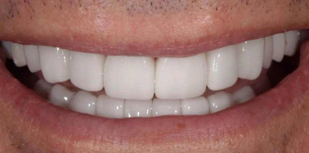 Veneers results, after treatment