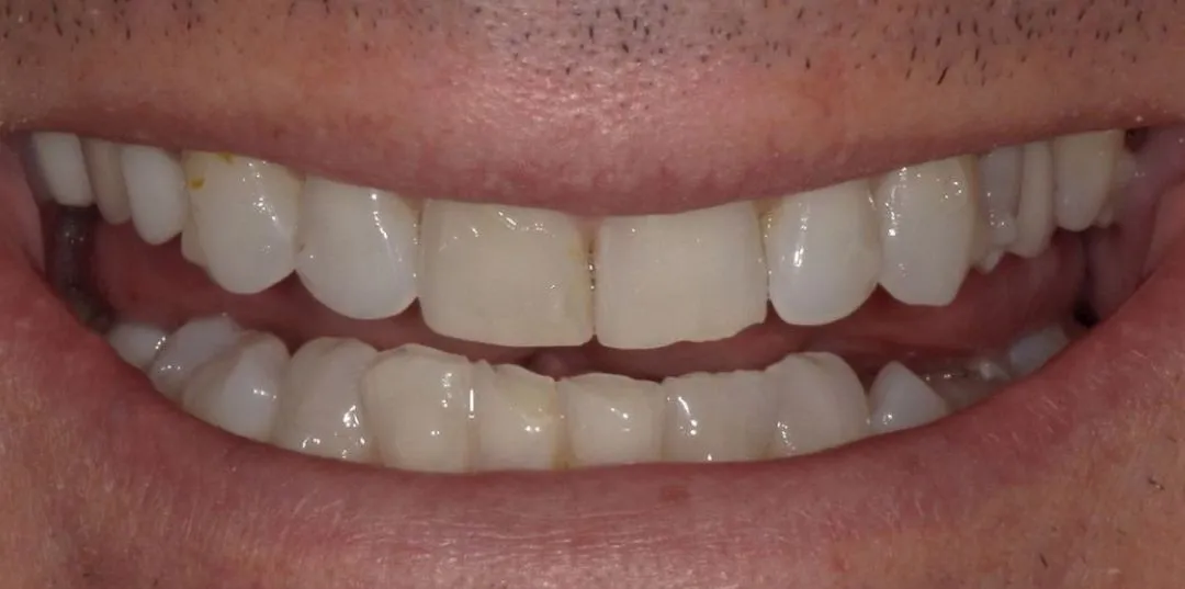before and after treatment
