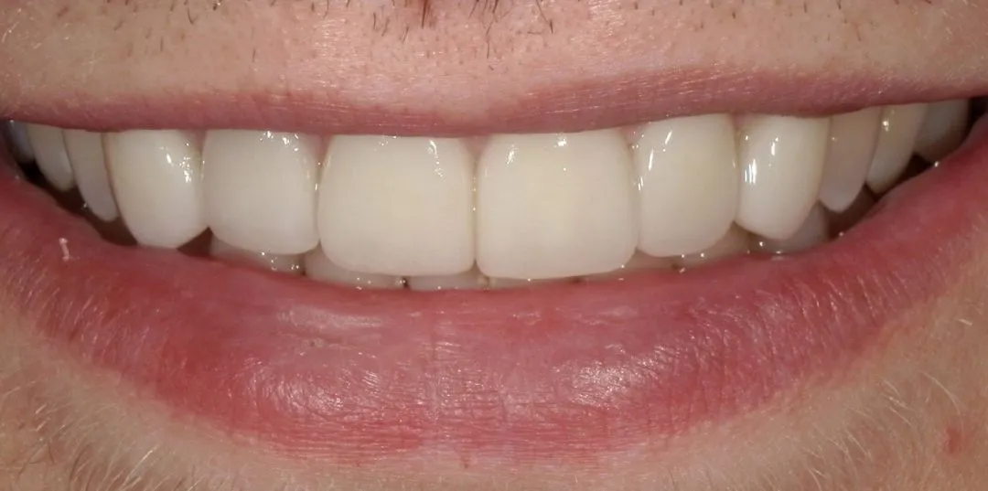Veneers results, after treatment