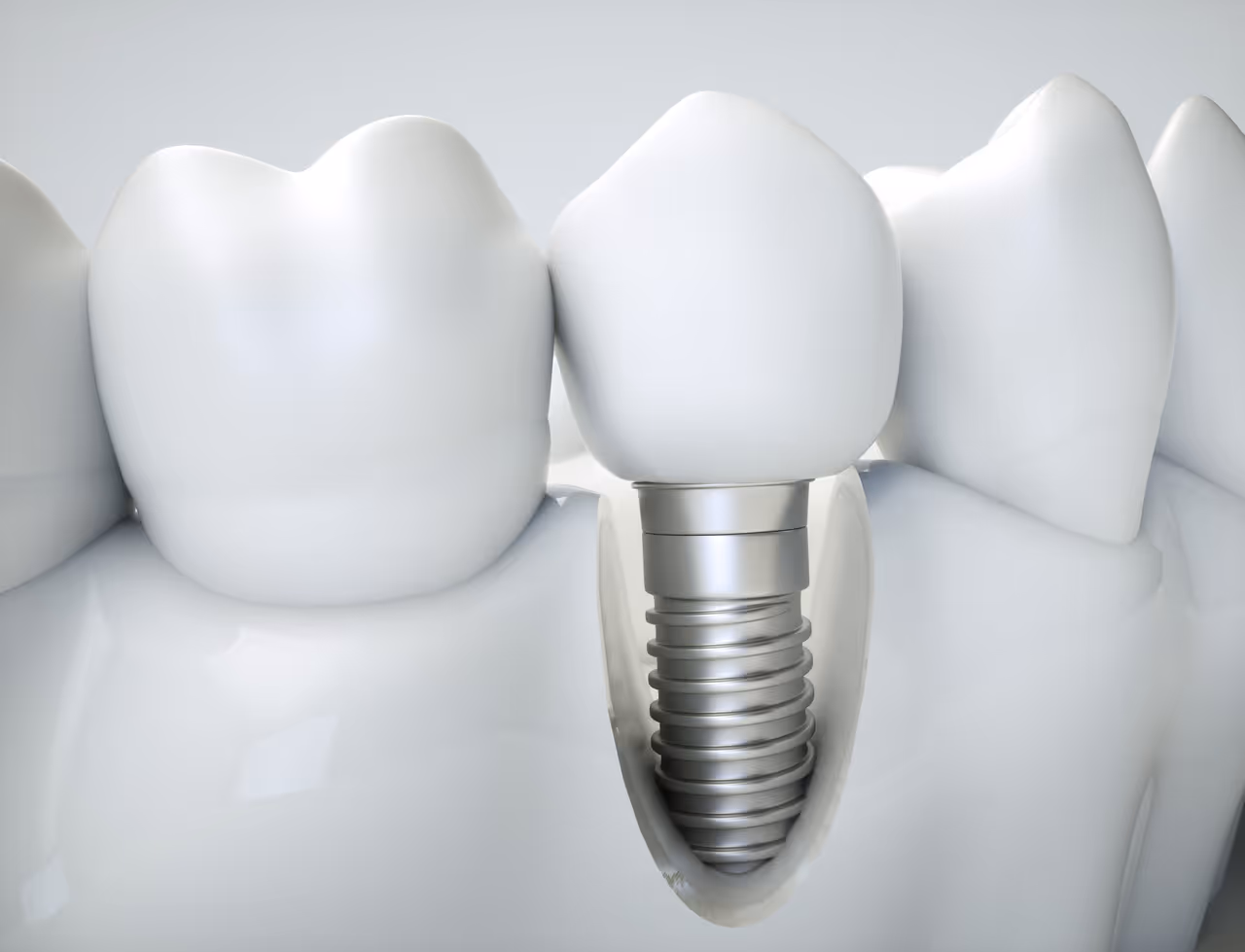 Tooth Extraction and Implant Timeline: Key Phases of the Process