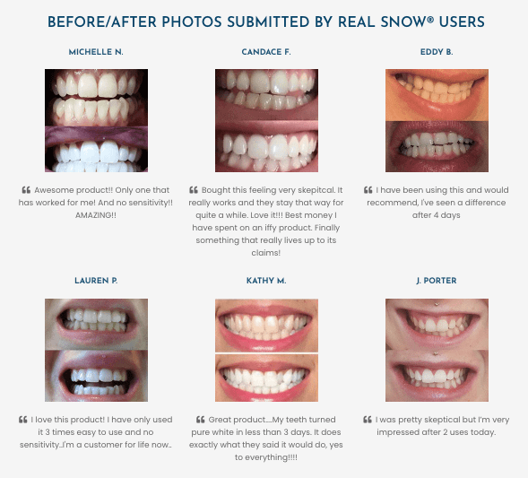 Snow teeth before and after