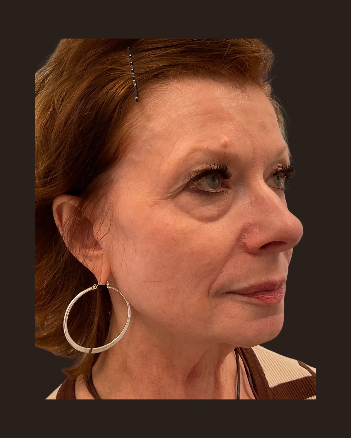 After a Morpheus8 series showing firmer skin and improved definition along the lower face