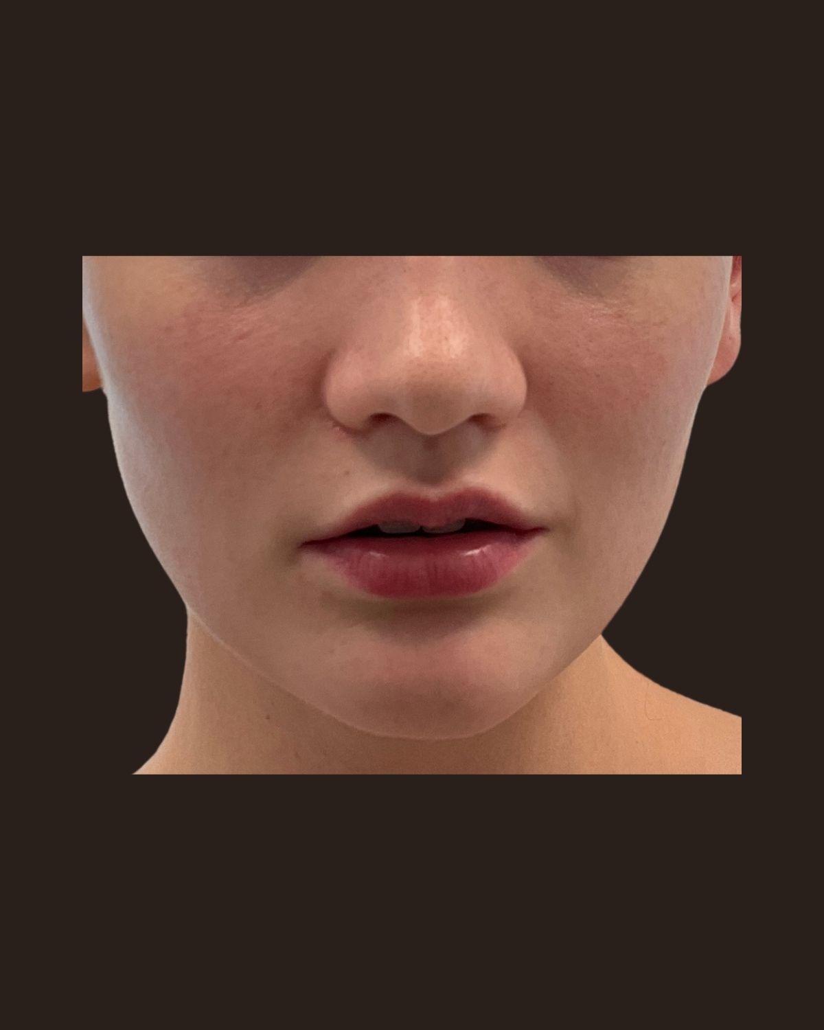Before lip filler showing uneven lip proportion and loss of definition