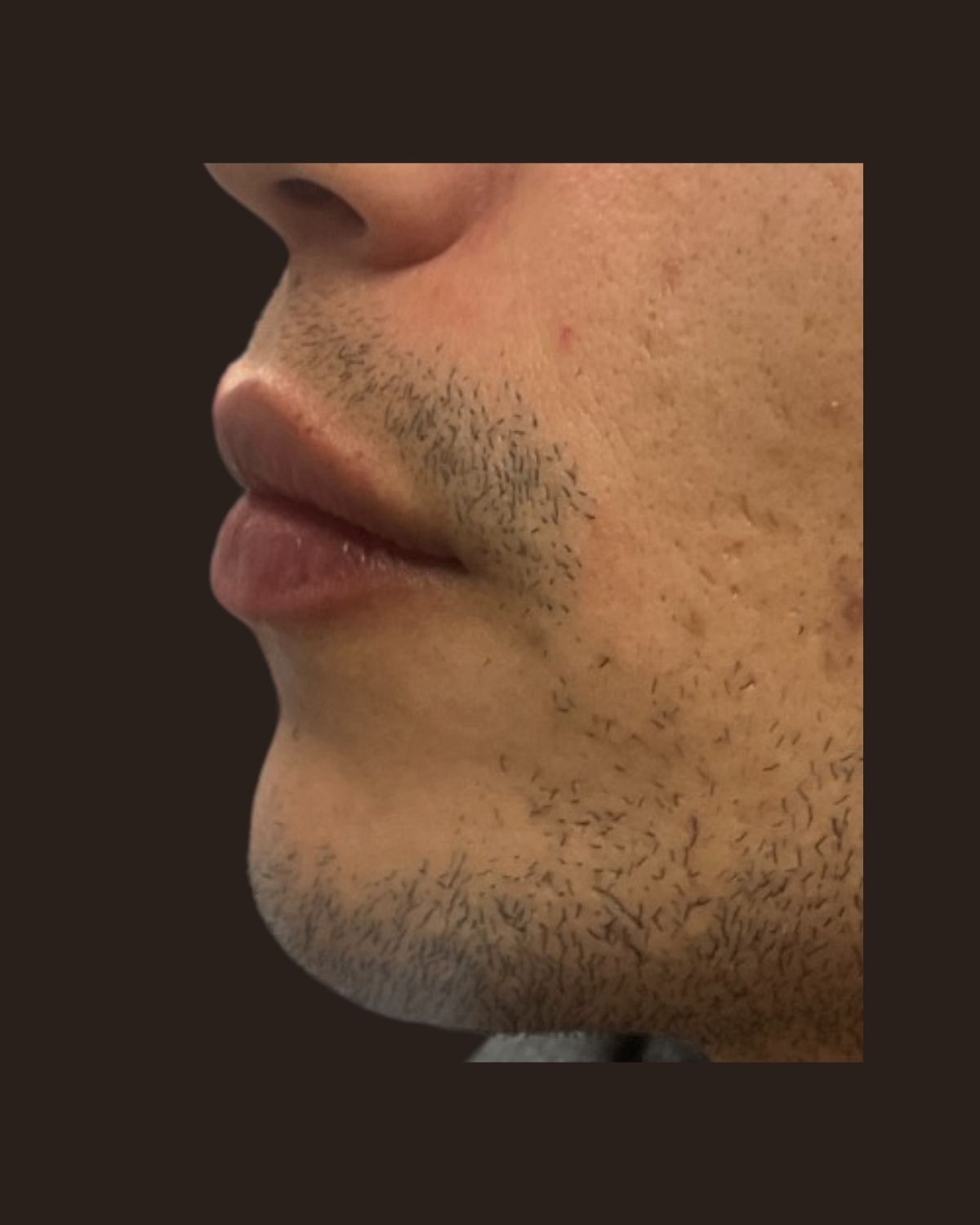 After lip filler showing added volume with the natural lip border preserved