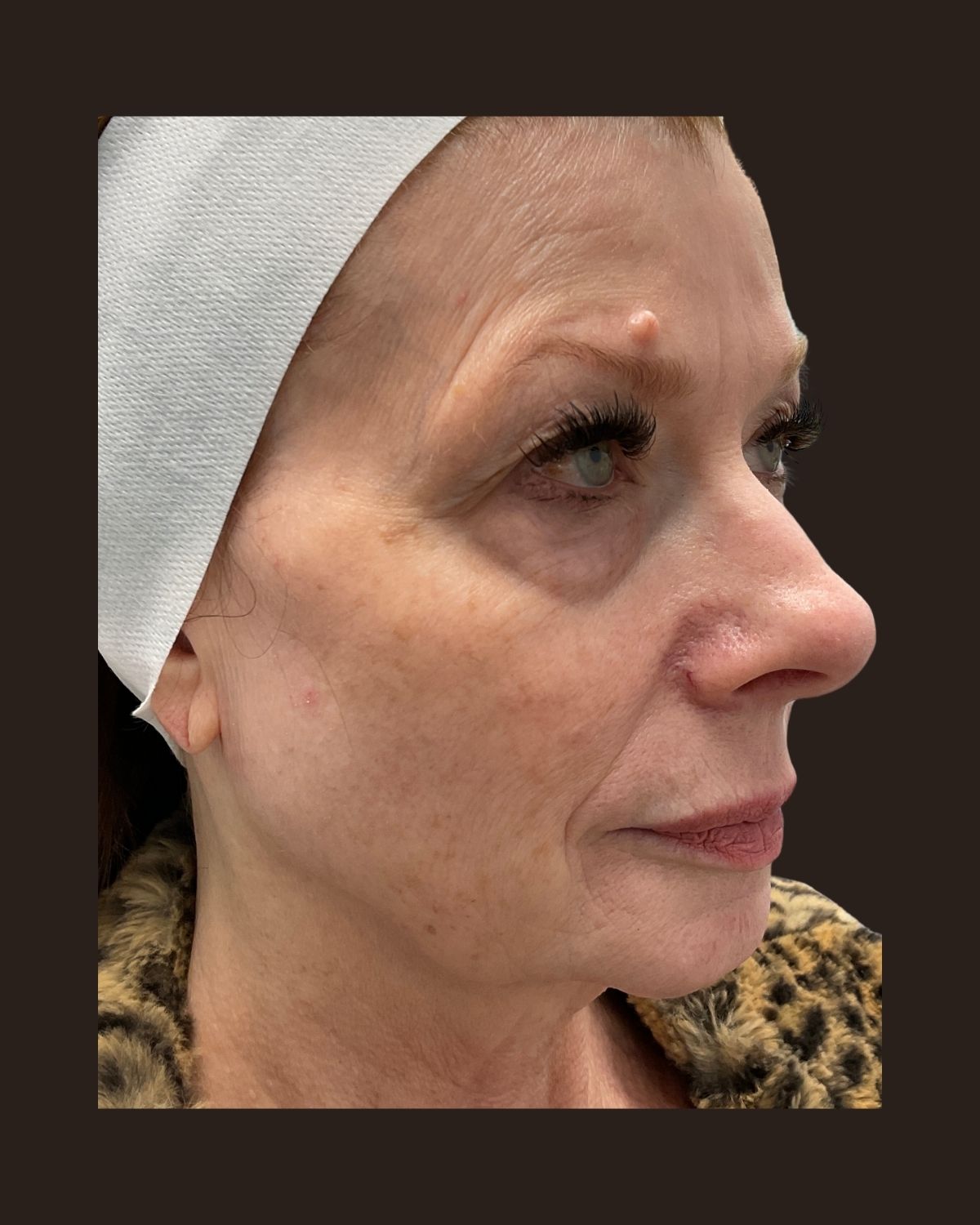 Before Morpheus8 showing skin laxity and softened contour across the lower face